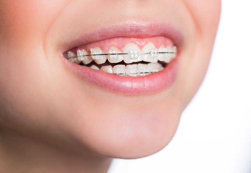 Woman with teeth braces