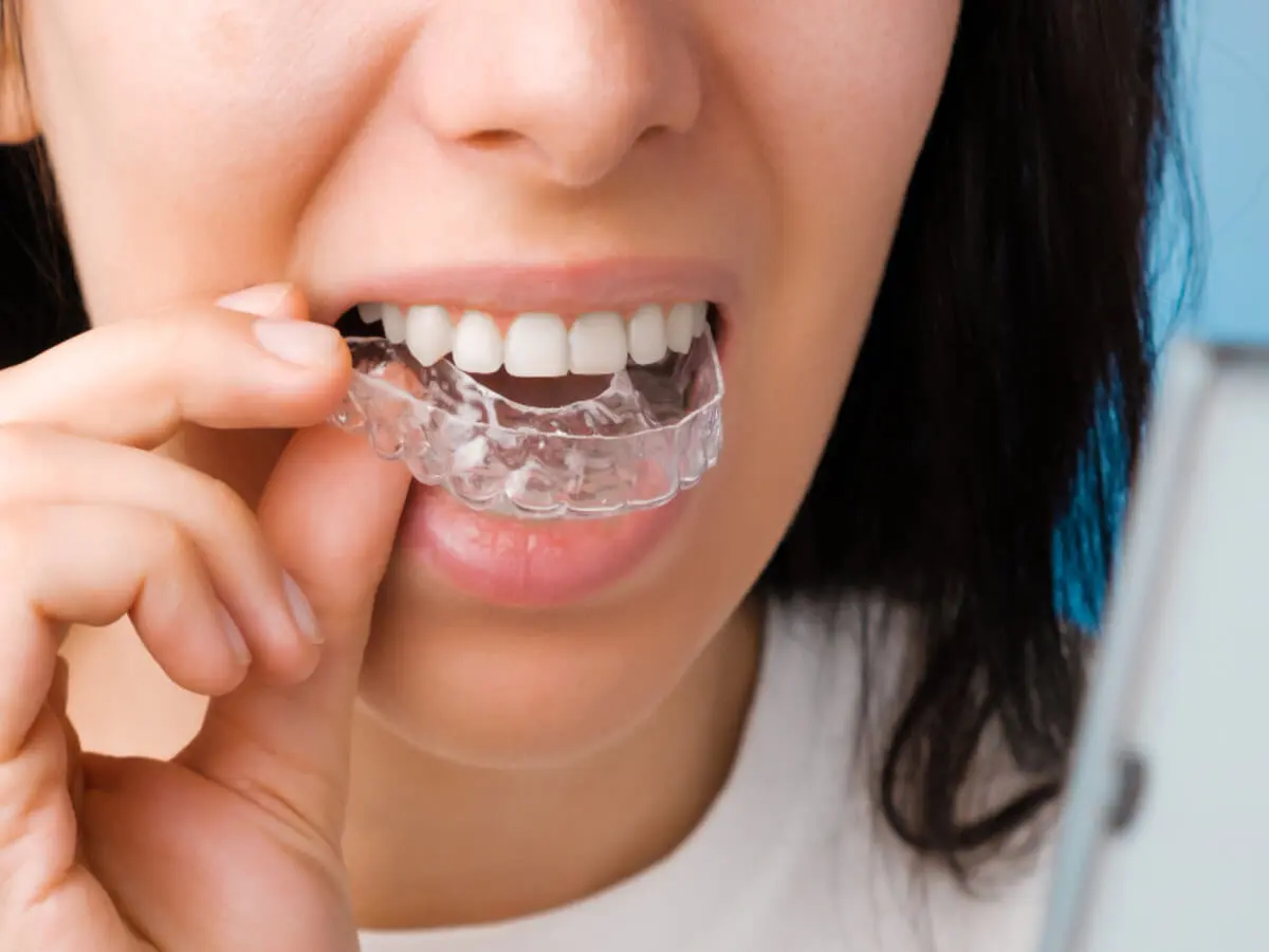 invisalign