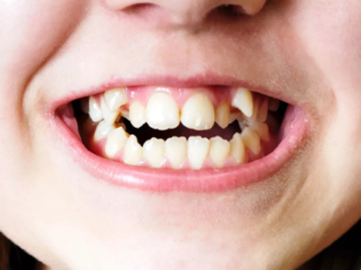 children crowded teeth