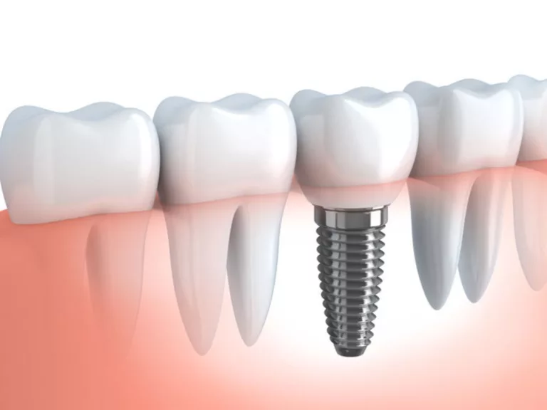 dental implant