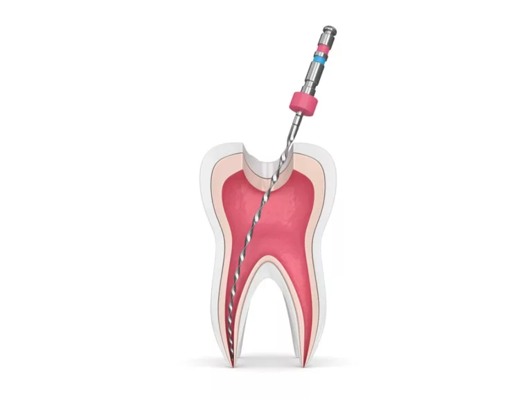 root canal treatments