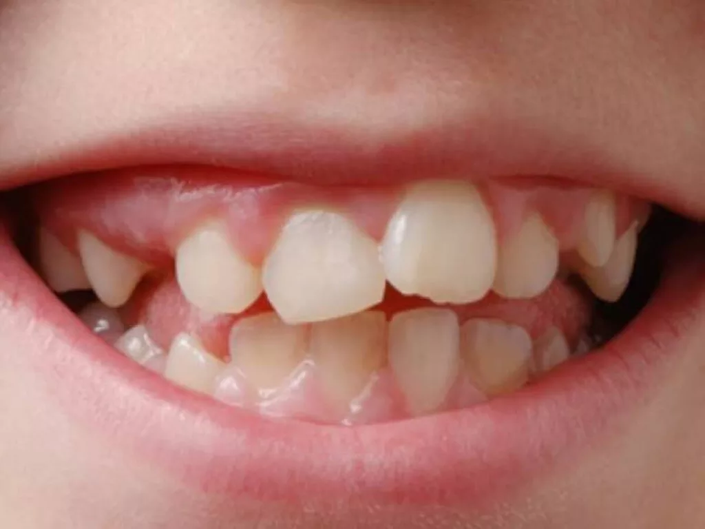 teeth of children dentistry