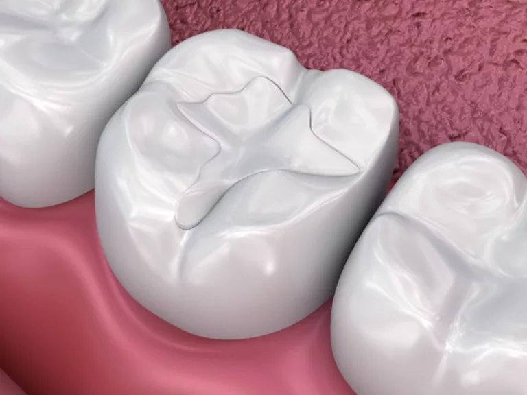 tooth coloured fillings