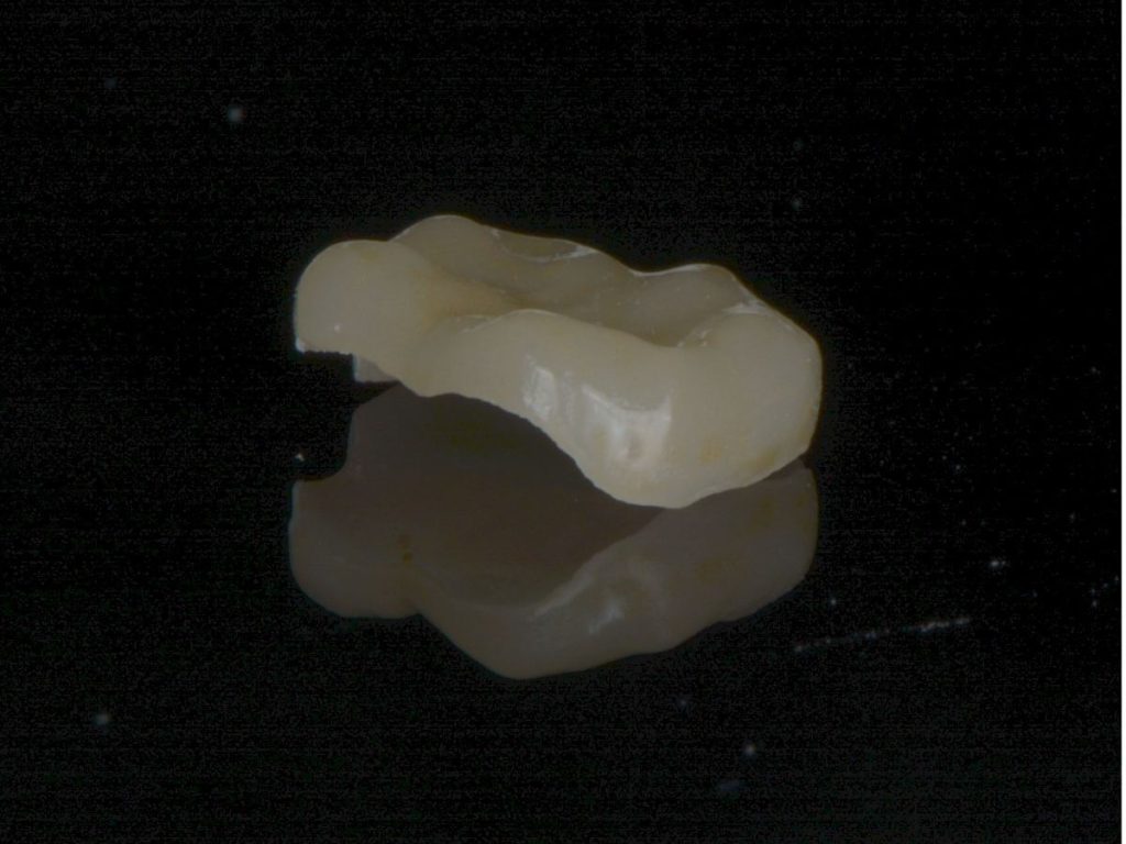 ceramic bridge for adjacent teeth