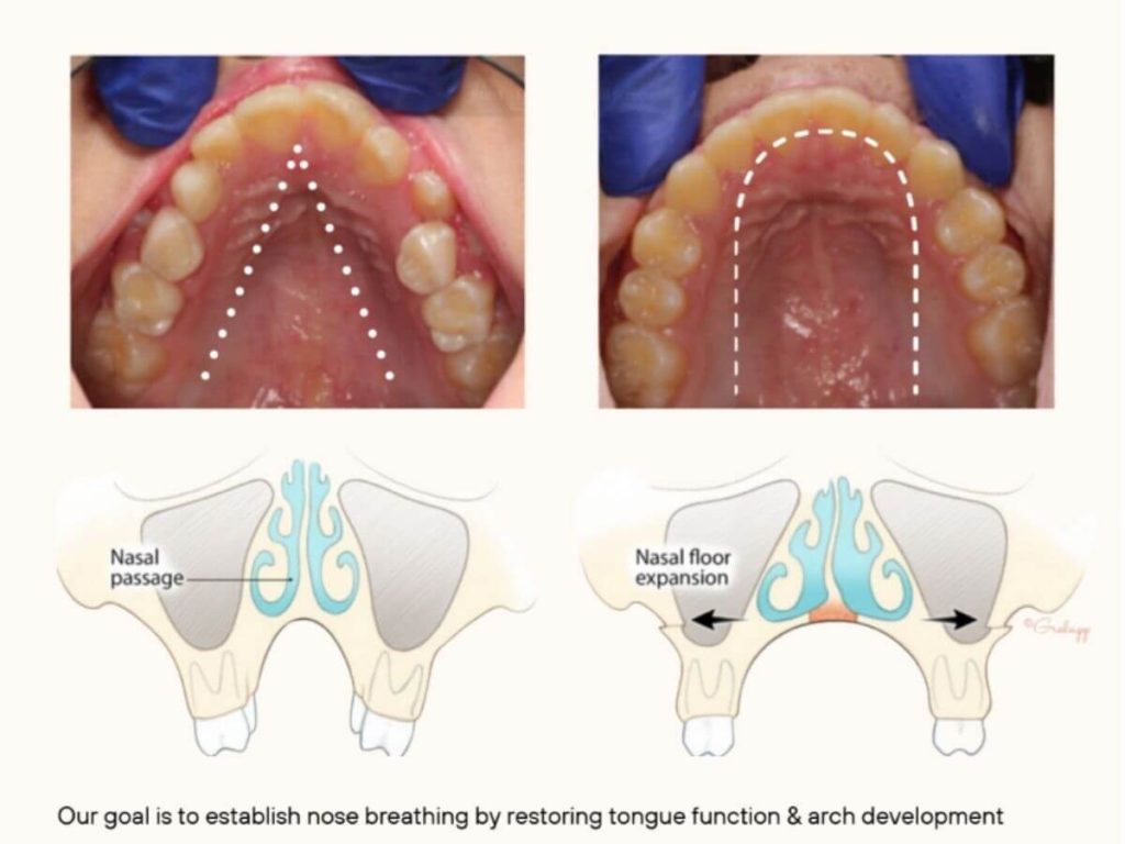 insufficient habitual nasal breathing