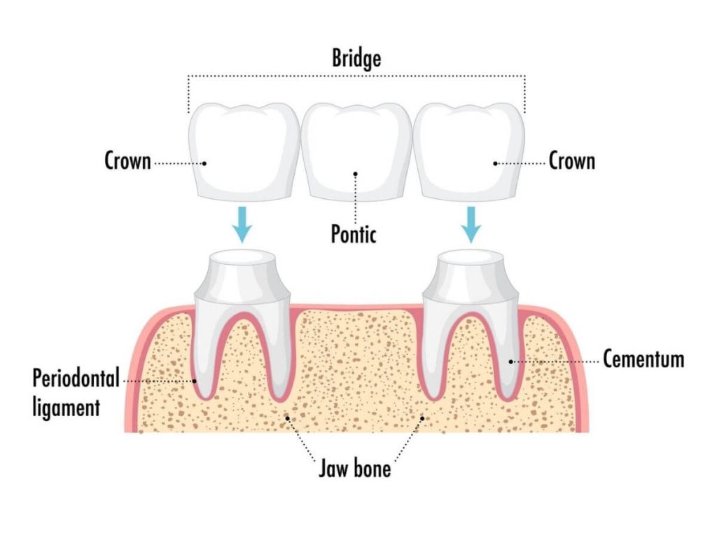 missing teeth