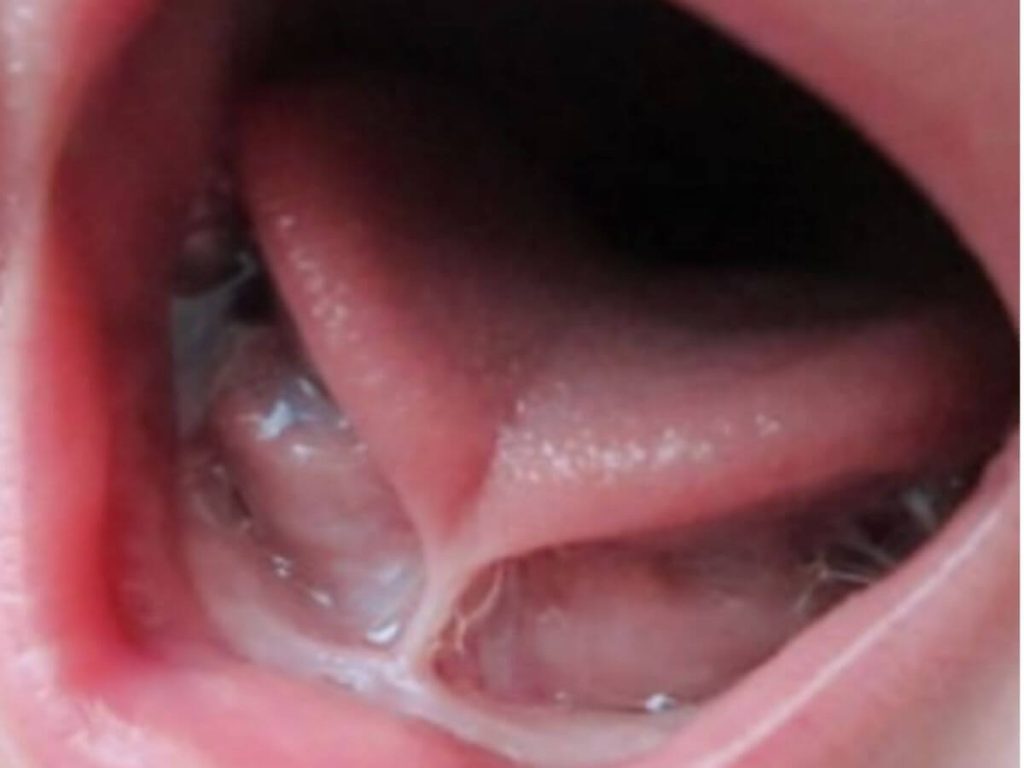 tongue and facial muscles