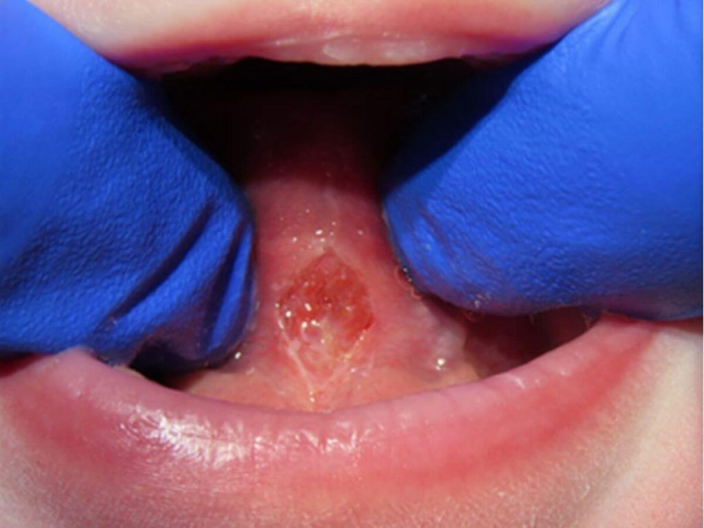 after tongue tie procedure