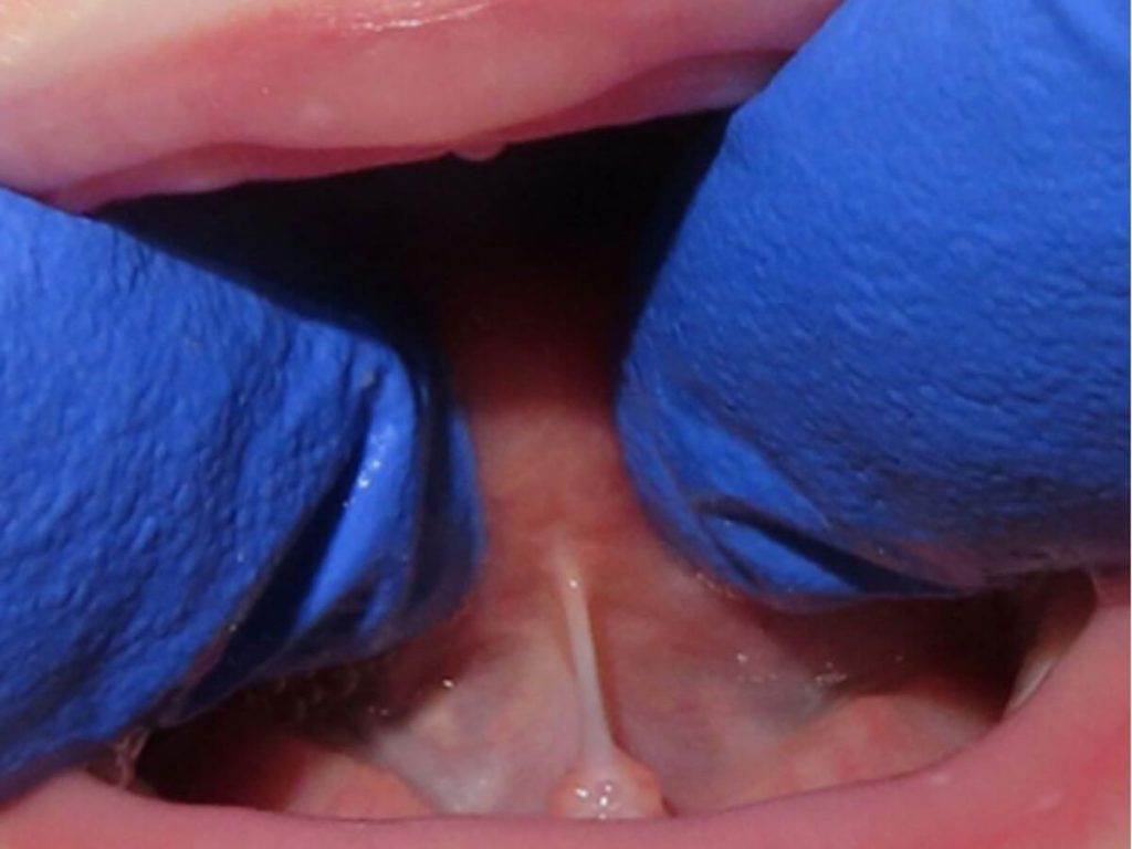 before tongue tie treatment