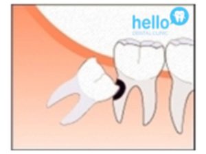 cavity or tooth decay