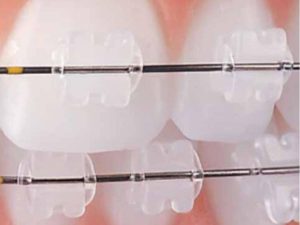 ceramic brackets