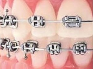 conventional brackets