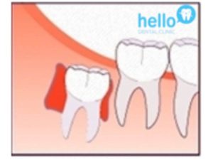 cyst formation