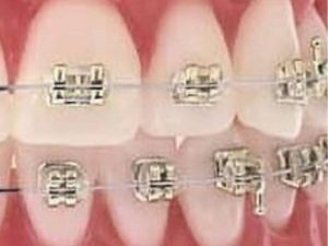 iconix brackets