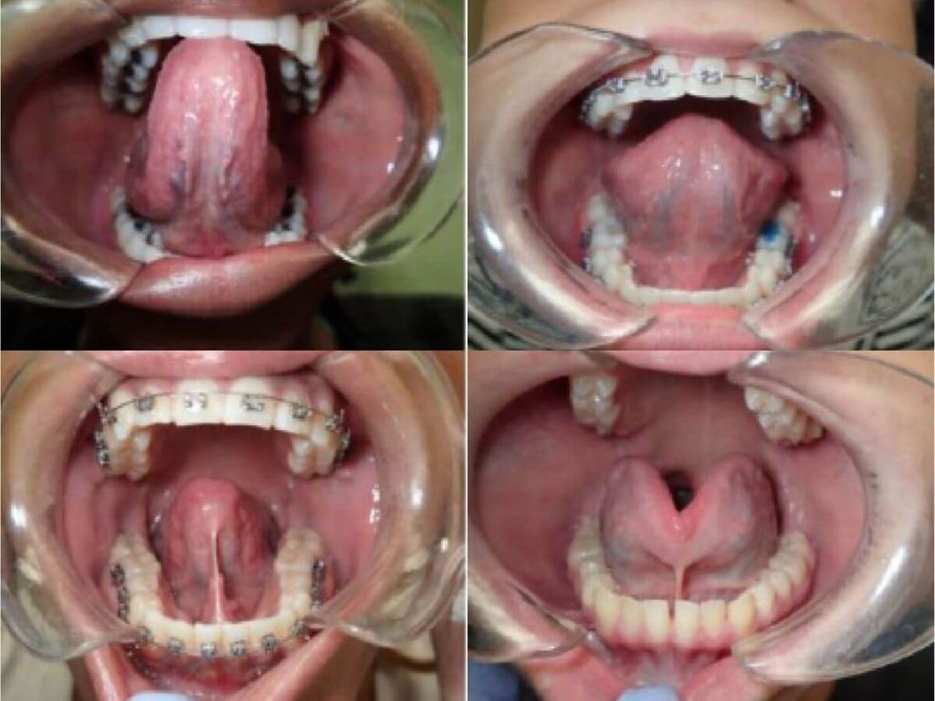 lip tie in adults