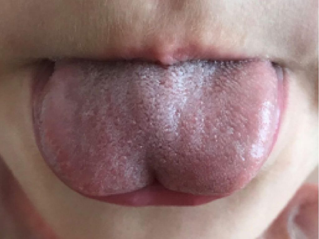 lip tie in older children