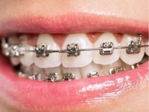 self ligating brackets