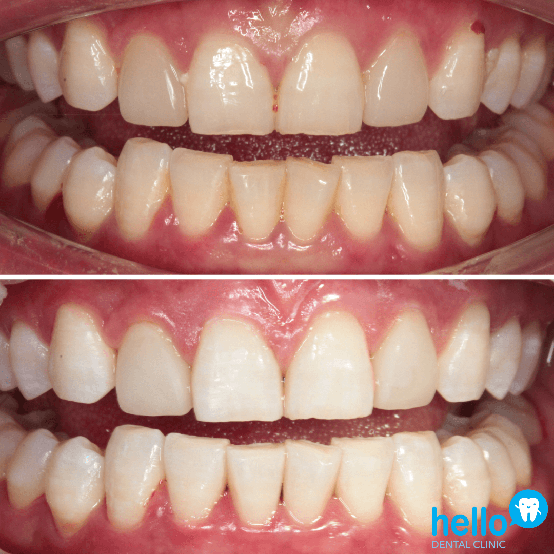 Dentist for Teeth Whitening (KL) Kuala Lumpur Hello Dental