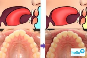 Normal Tongue vs Tongue Tie Hello Dental Clinic