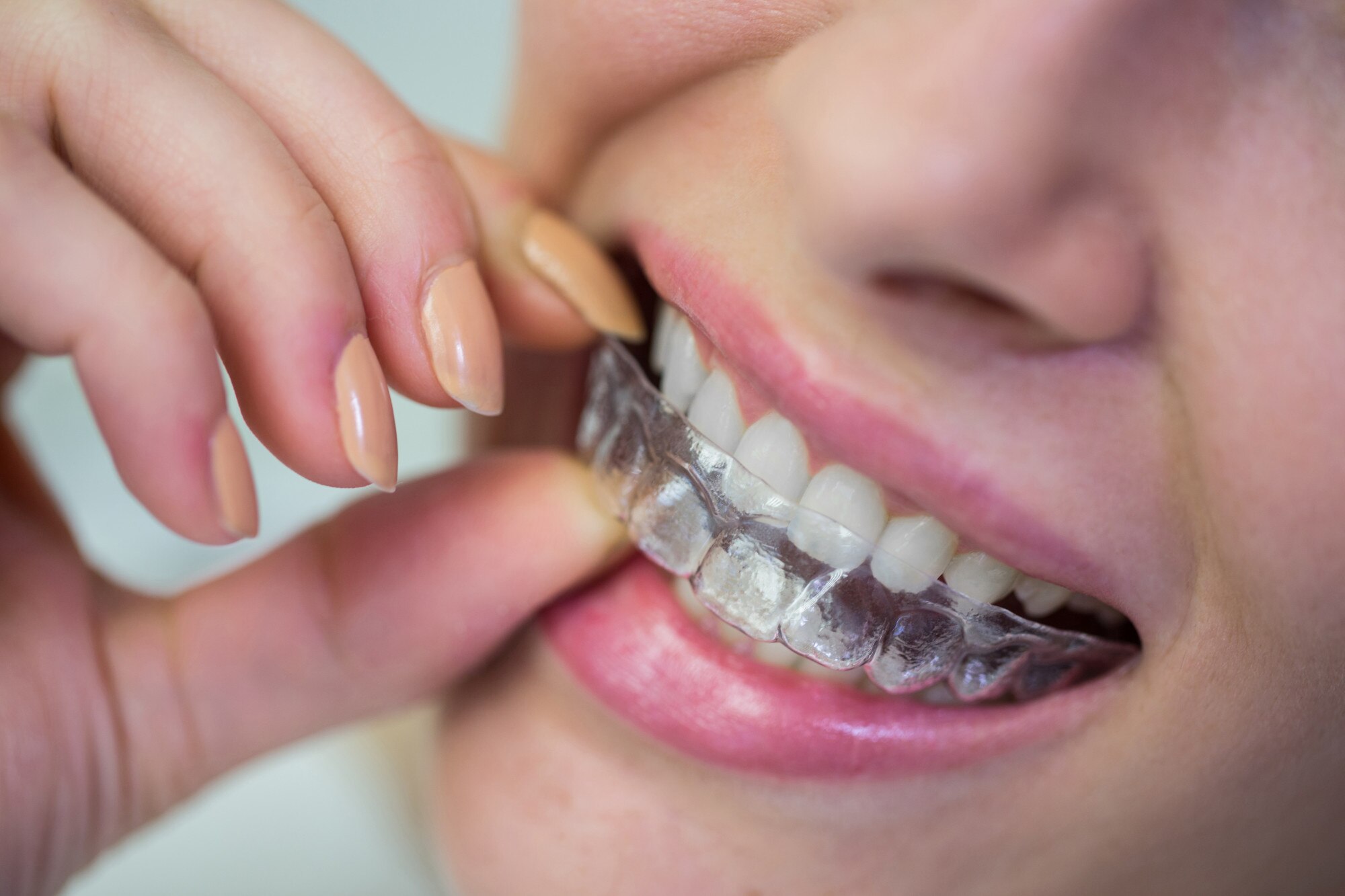 Clear Aligner