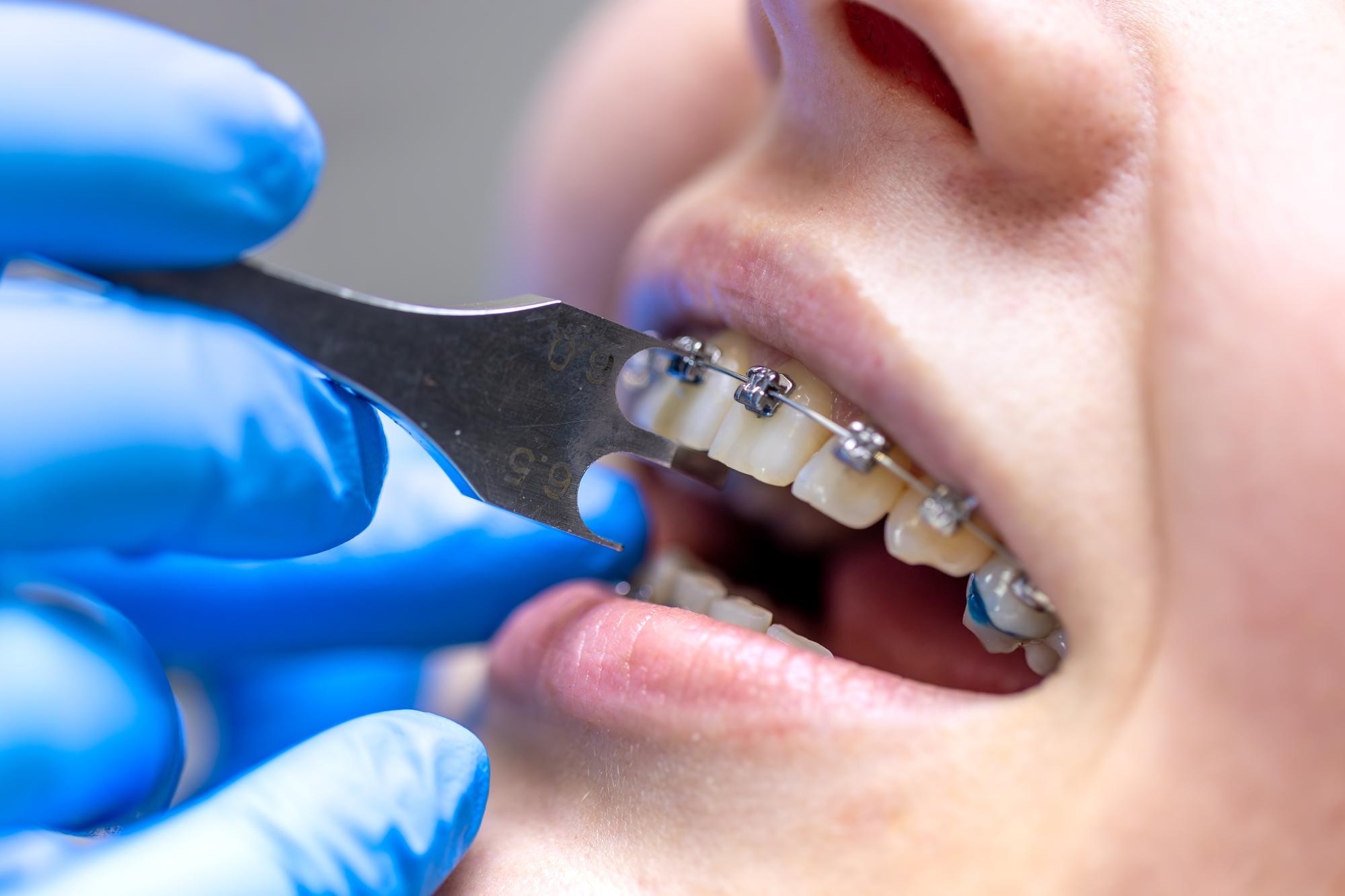 Braces