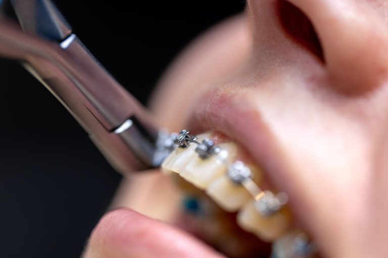 Conventional metal braces model used for orthodontic treatment in Malaysia