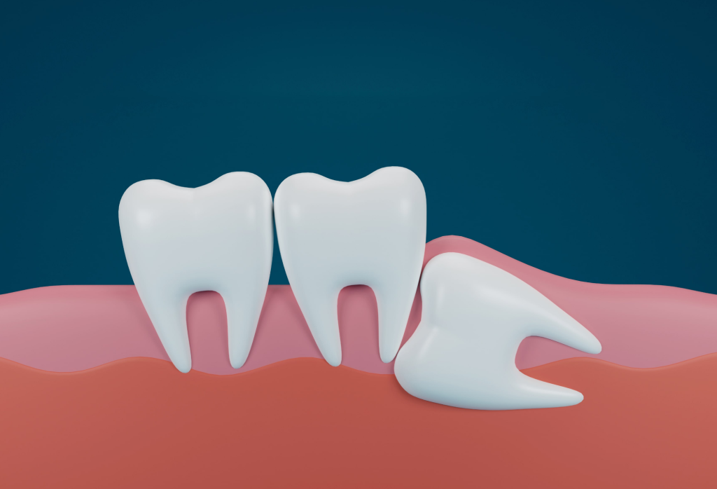 Wisdom Tooth Extraction: Why It’s Necessary and What to Expect