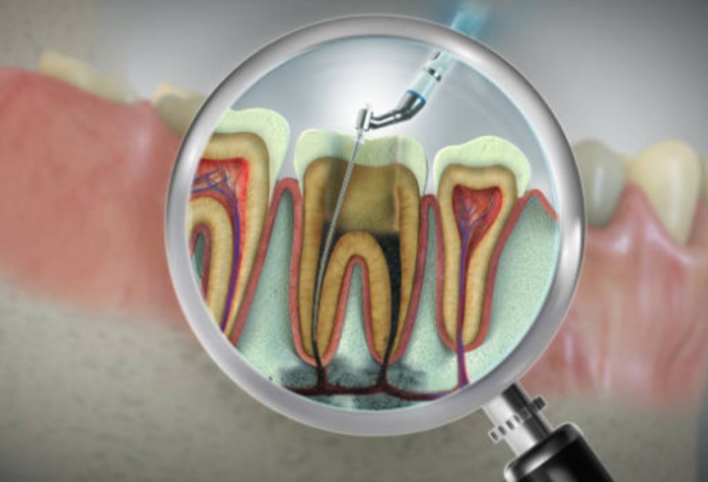 Root Canal Treatment Cost in Malaysia: How Much and Why It Matters