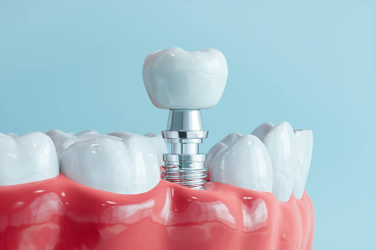Dental Implants in Malaysia: Are They Worth the Cost?