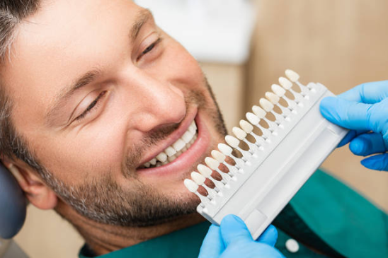 A Low-Risk Smile Makeover: Why Composite Veneers Appeal to First-Timers