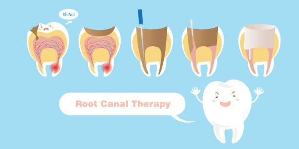 Tooth diagram showing root canal procedure from pulp removal to final crown.