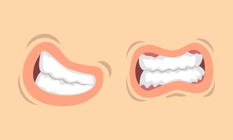 Comparison of relaxed vs clenched teeth, illustrating tension and possible teeth grinding (bruxism)