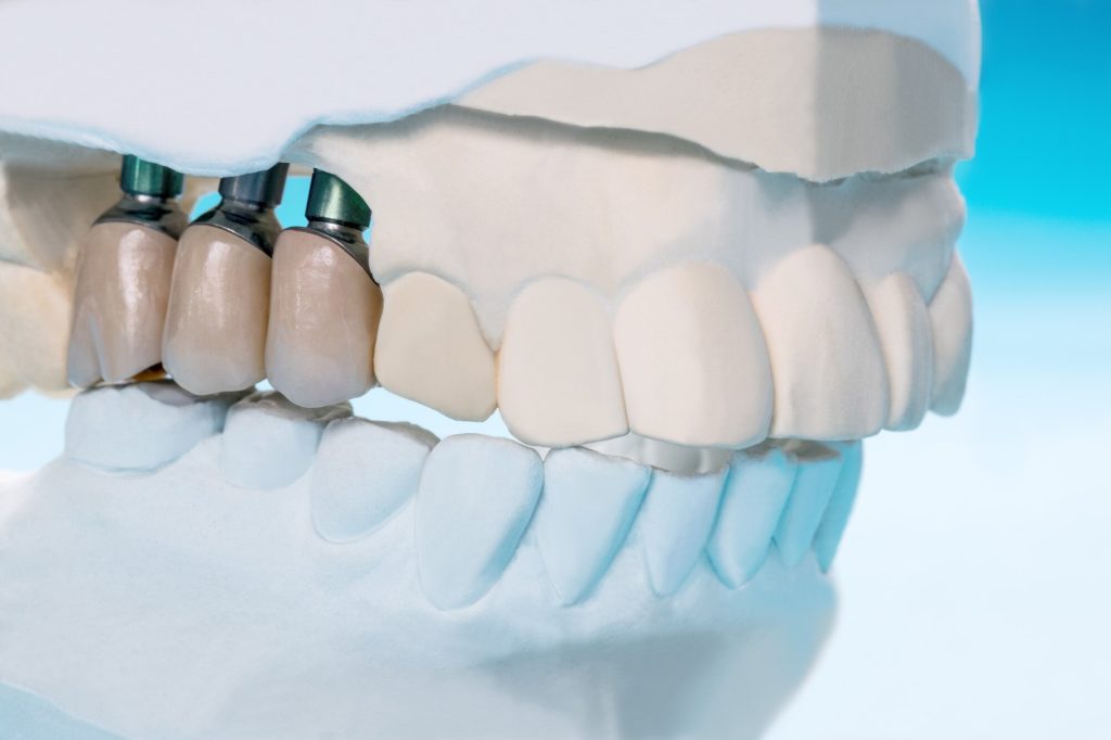 Immediate Dental Implants and Important Things to Think About