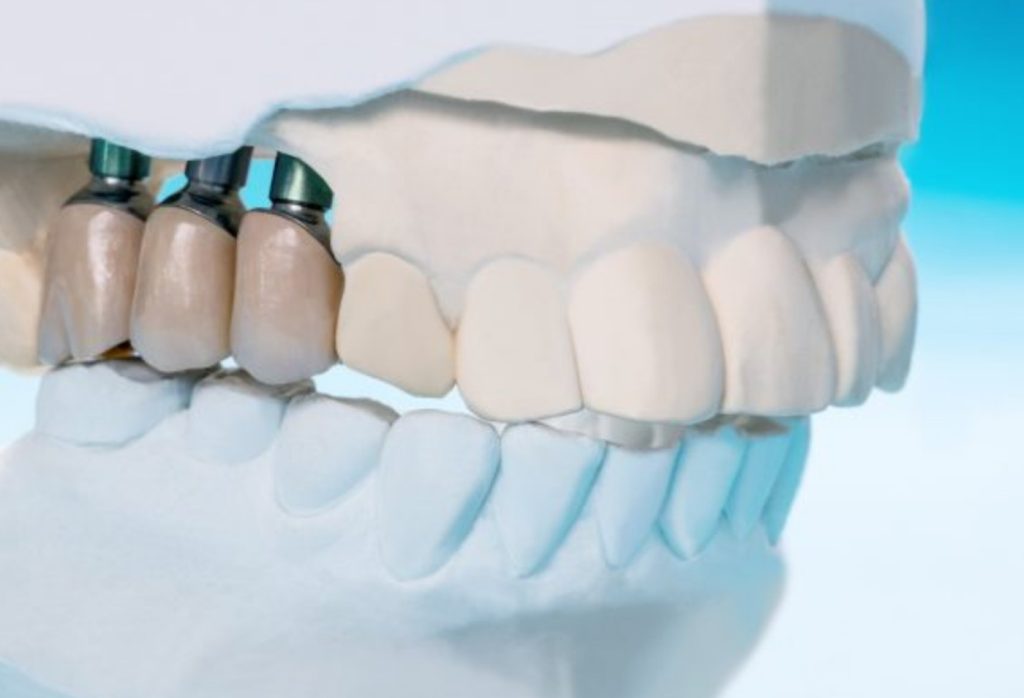 Immediate Dental Implants and Important Things to Think About