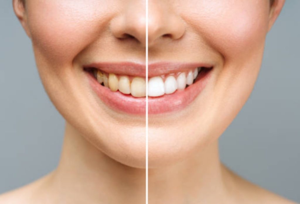 Everything You Should Know About Scaling & Root Planing