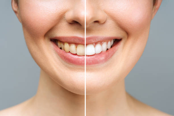Scaling can improve your teeth