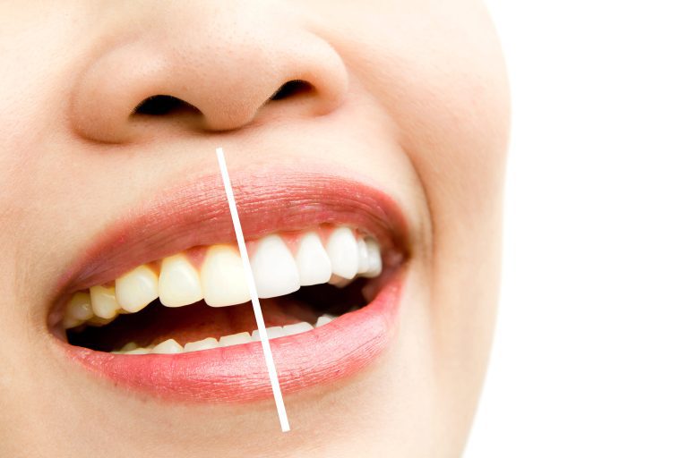 Mouth showing side-by-side difference between yellow teeth and whitened teeth