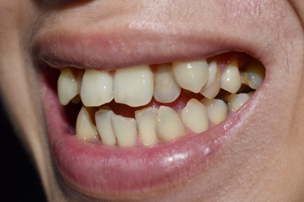 Why Children Develop Crooked Teeth and How to Support Healthy Jaw Growth