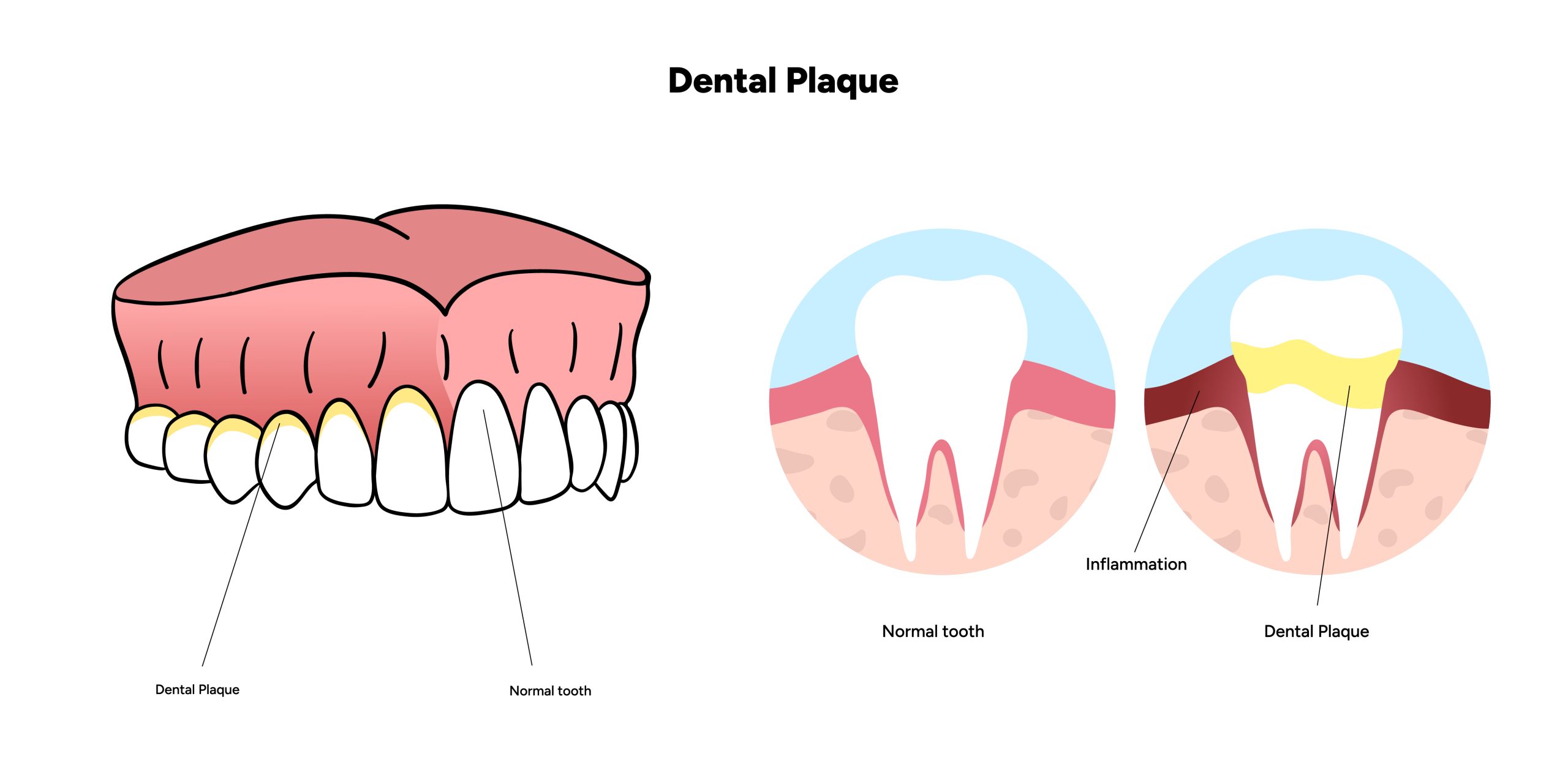 Illustration comparing a healthy tooth to a tooth with plaque buildup