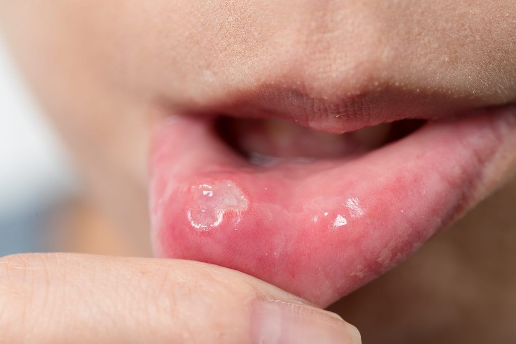 Mouth Ulcers: Causes, How to Relieve Them & When to See a Dentist