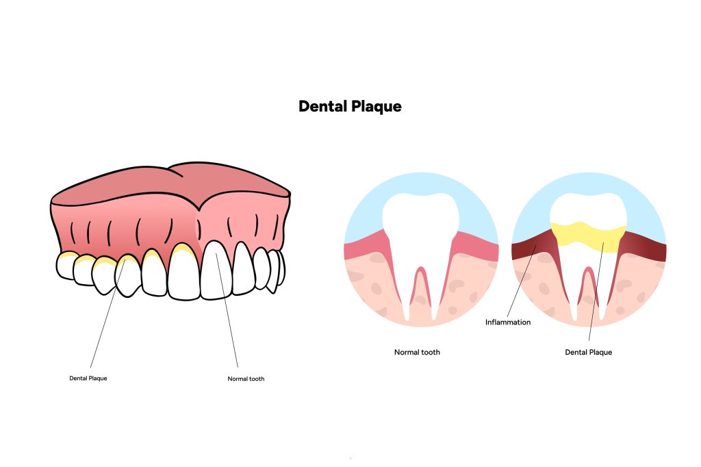What Is a Cavity, and How Does It Form?