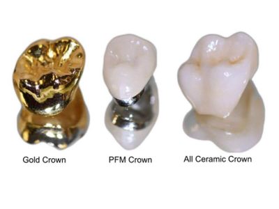 gold ceramic and porcelain teeth